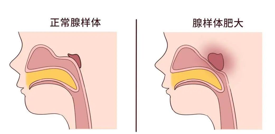 為什么現(xiàn)在患腺樣體肥大的孩子越來越多？聽聽成都民生耳鼻喉醫(yī)院怎么說