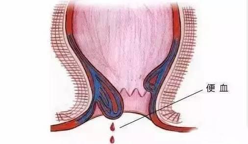保定東大肛腸醫(yī)院丨肛腸疾病千萬別硬抗，這六種癥狀一定要去醫(yī)院！