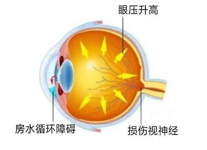 合肥愛爾眼科：青光眼嚴重嗎？它可能會致盲！