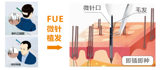 杭市一祝飛醫(yī)生植發(fā):實現(xiàn)科技創(chuàng)新性升級,賦能高品質(zhì)植發(fā)體驗