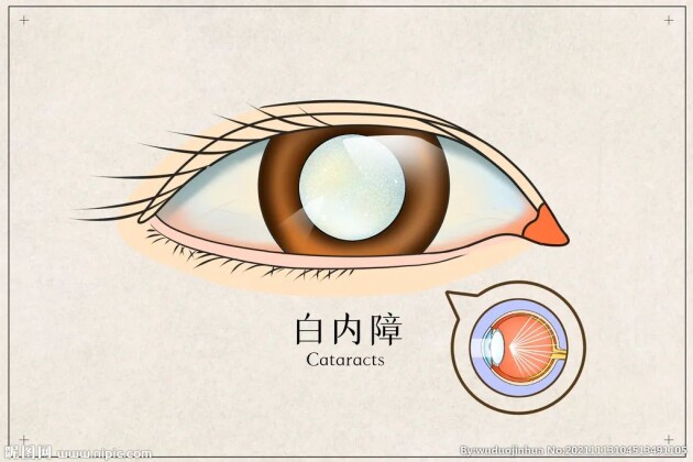 眼前好像蒙了一層霧，是白內(nèi)障嗎？這5大癥狀，轉(zhuǎn)發(fā)給父母自查——福州愛(ài)爾