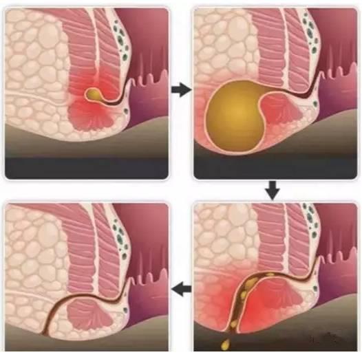 保定東大肛腸醫(yī)院看肛腸疾病怎么樣？這種高發(fā)的肛門(mén)疾病發(fā)病率僅次于痔瘡，卻幾乎無(wú)法自愈！!!!!!