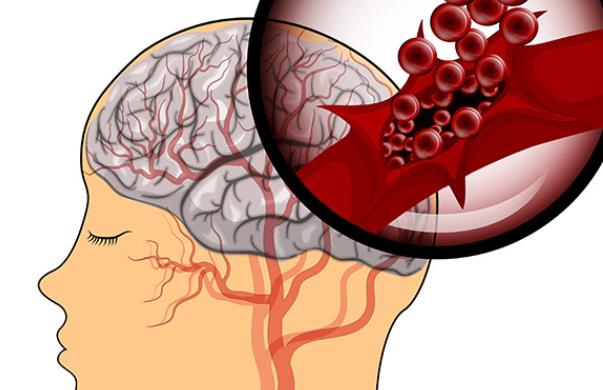 腦出血怎么治療 腦出血偏癱多久恢復(fù)正常