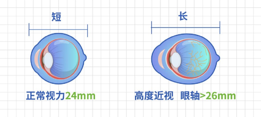 合肥愛(ài)爾眼科：盡早做好青少年近視防控，遠(yuǎn)離高度近視危害！