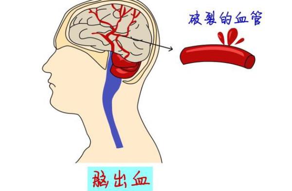 哪些人腦溢血概率高 為什么三高下載容易腦溢血