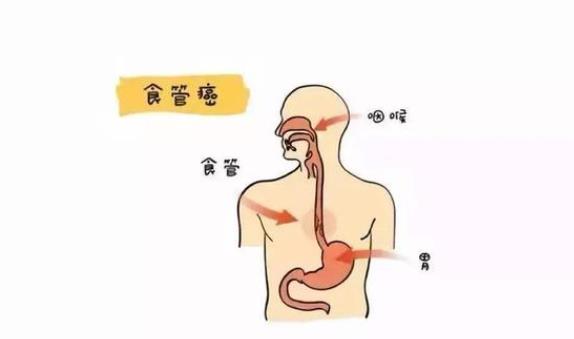 如何預(yù)防食道癌 食道癌吃什么食物好