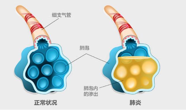 流感疫苗可以預(yù)防肺炎嗎 ？支原體肺炎更易侵襲小學(xué)生嗎？