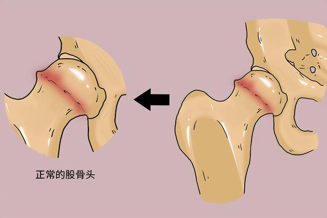 股骨頭壞死平常怎么養(yǎng)？專家推薦天然中成藥