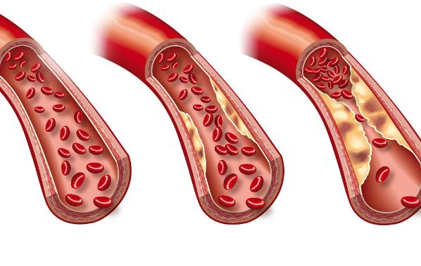 高血脂的癥狀有哪些 ？高血脂會引起高血壓嗎？