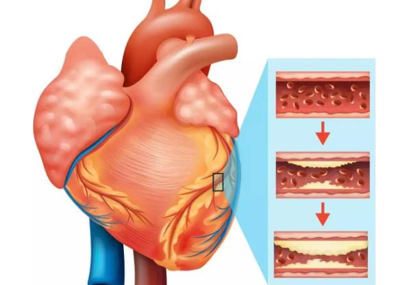 冠心病是心臟病嗎？冠心病是傳染病嗎？
