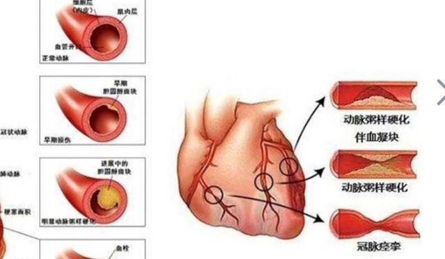 冠心病吃什么好？治療冠心病要多少錢？