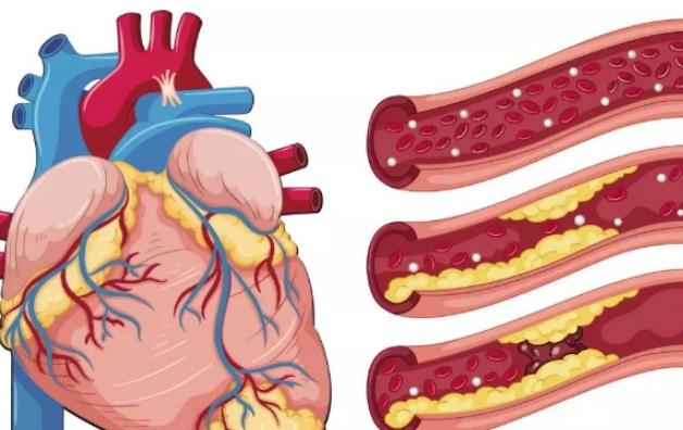 冠心病預(yù)防與保健 ？冠心病的分類？