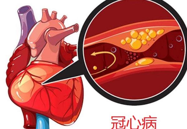 冠心病會引起頭暈嗎？冠心病會引起腳腫嗎？