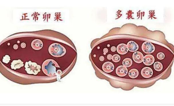 樣預(yù)防多囊卵巢？多囊為什么肚子大？