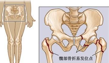 這些股骨頭壞死信號不容忽視，早期股骨頭壞死的保守治療