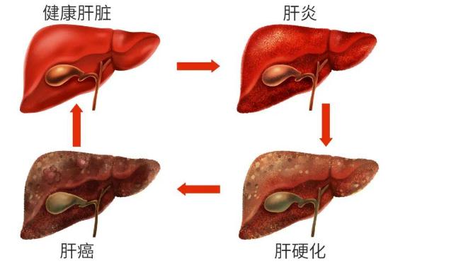 丁型肝炎有什么危害呢？丁型肝炎的癥狀有什么呢？