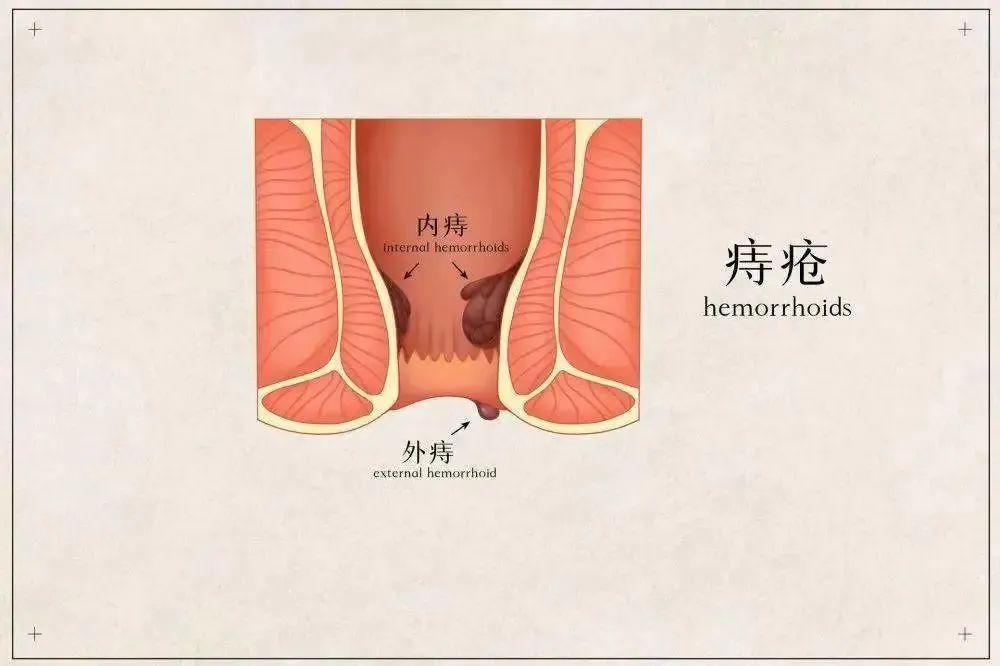 包頭東大肛腸?？漆t(yī)院詳解痔瘡不痛不癢不用管?這5種痔瘡真的留不得!