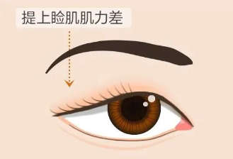 合肥愛(ài)爾專(zhuān)家科普：上瞼下垂＝眼皮松弛？其實(shí)真相是……