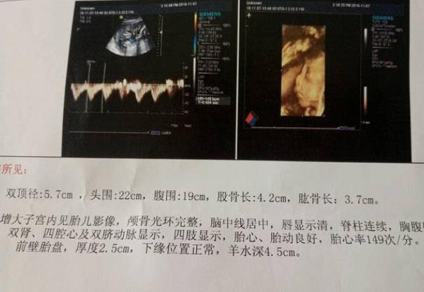 四維彩超篩查范圍廣嗎 五個半月可以做四維嗎