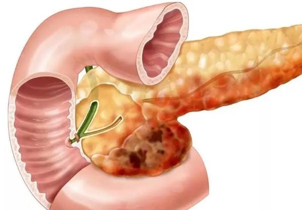 胰腺炎為什么不能喝水？狗狗胰腺炎能治好嗎？