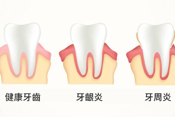 牙周炎能吃海鮮嗎？牙周炎如何自我判斷？