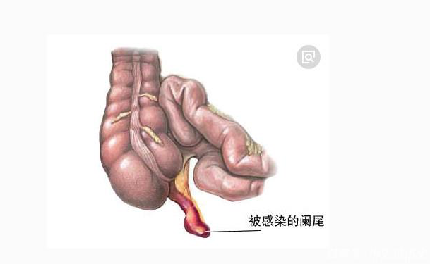 急性闌尾炎保守治療需要幾天 急性闌尾炎保守治療會復(fù)發(fā)嗎