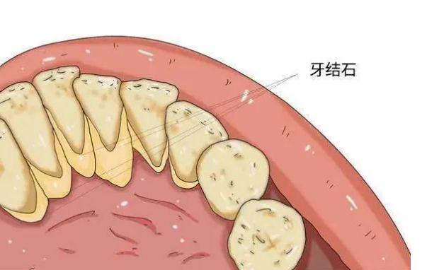 牙周炎可以用沖牙器嗎 ？牙周炎吃什么好？