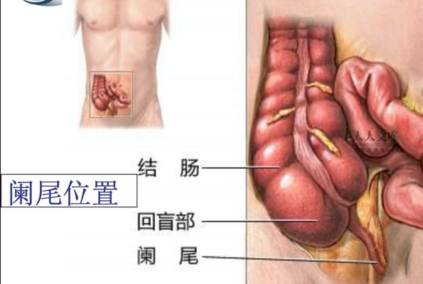 慢性闌尾炎有危險(xiǎn)嗎 慢性闌尾炎不治療會(huì)怎樣