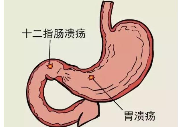 得胃潰瘍有哪些危害 胃潰瘍多久能好