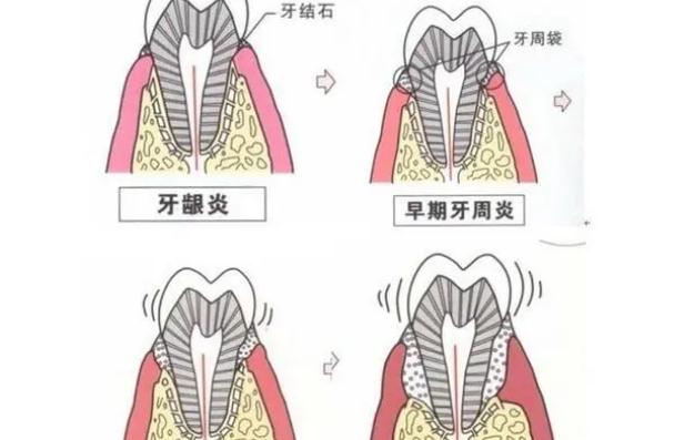 牙周炎會(huì)癌變嗎？牙周炎會(huì)病變嗎？