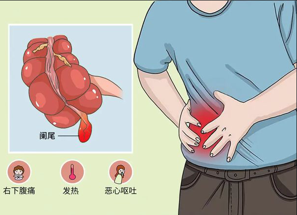 慢性闌尾炎懷孕有影響嗎 慢性闌尾炎會不會穿孔