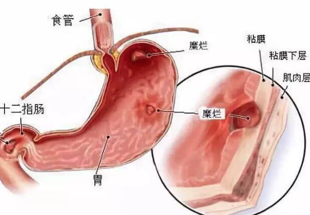 胃潰瘍能癌變嗎 胃潰瘍惡變一定是癌嗎