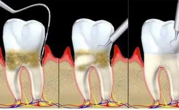 牙周炎跟腎虛有關(guān)系嗎？牙周炎跟上火有關(guān)系嗎？