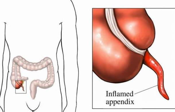 闌尾炎會死人嗎 闌尾炎會吐嗎