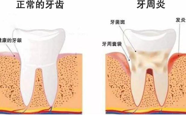 牙周炎檢查？牙周炎小偏方？