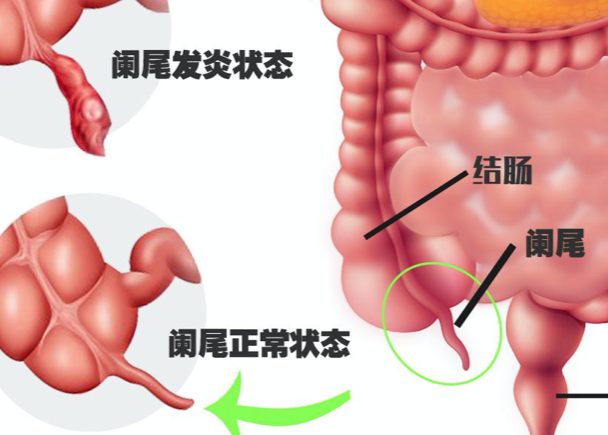 慢性闌尾炎會(huì)引起腰疼嗎 右下腹經(jīng)常性疼痛