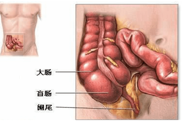 怎樣預(yù)防闌尾炎的發(fā)生 闌尾炎有什么忌口