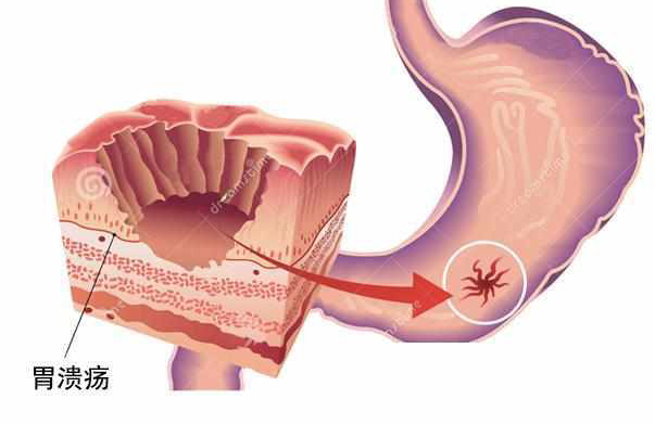 胃潰瘍可以喝酒嗎 乙醇破壞黏膜屏障遭