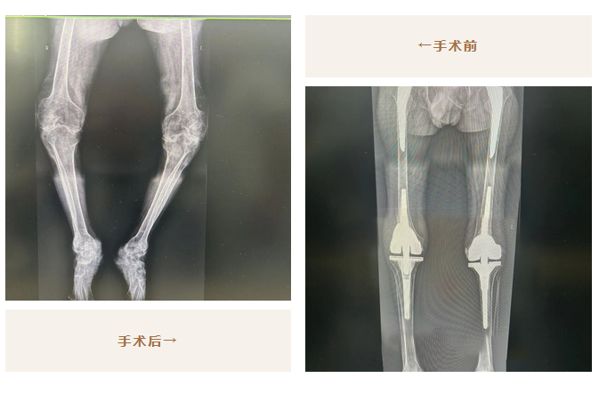 太厲害了！我院骨科助力26年不能站立的他，重新行走！