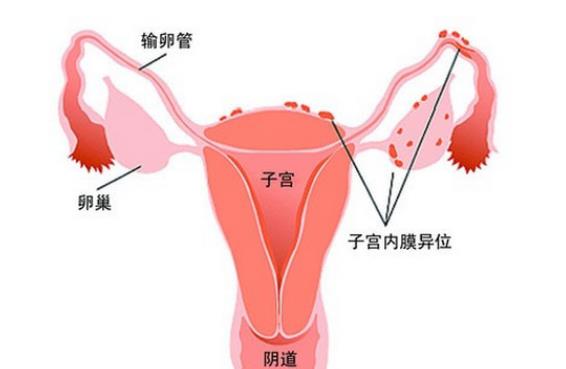 卵巢囊腫可以治好嗎 左側(cè)卵巢囊腫怎么辦