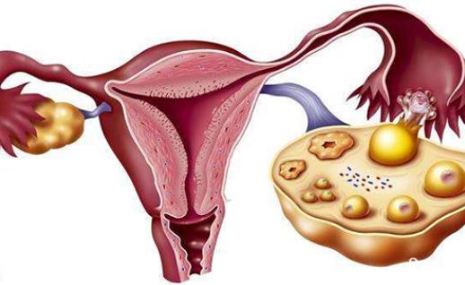 肥胖會(huì)導(dǎo)致多囊卵巢綜合征嗎 多囊卵巢綜合征有哪些危害