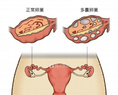 多囊卵巢綜合征是怎么引起的 多囊卵巢綜合征不治療可以嗎