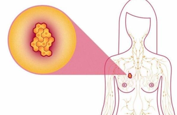 多大年齡容易乳腺增生 乳腺增生結(jié)節(jié)怎么回事