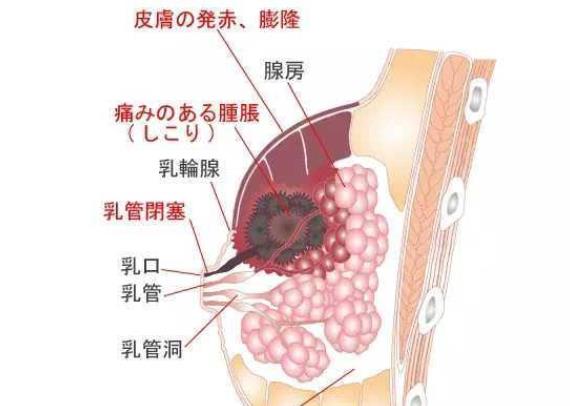 乳腺炎患者能功能嗎 如何才能根治乳腺炎