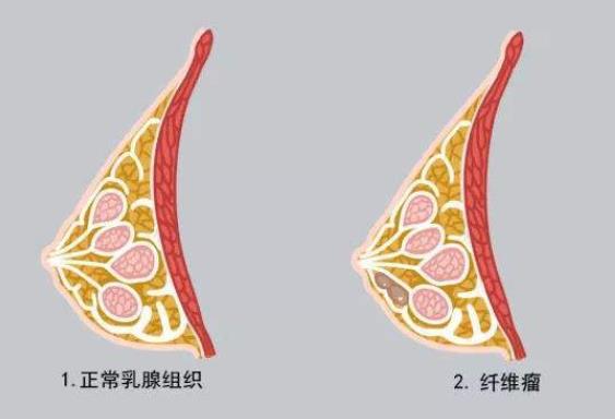 乳腺纖維瘤是微創(chuàng)治療嗎 乳腺纖維瘤微創(chuàng)手術費用是多少