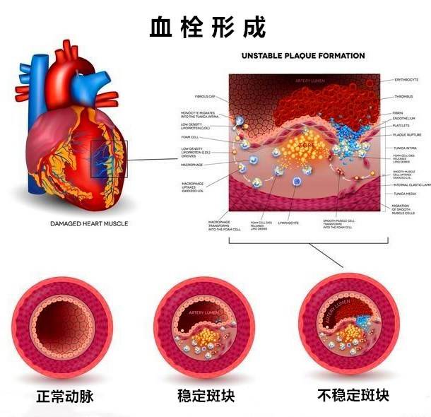 腦梗、頭暈、眼黑總是反復(fù)？血脈通栓化斑方就能調(diào)理！