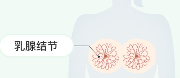 乳腺結(jié)節(jié)是怎么回事 乳腺組織導(dǎo)管乳小葉病變