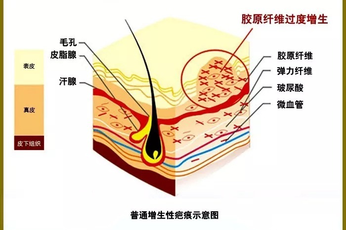 【沈陽膚康疤痕科普】之紋身疤痕，紋身雖美，疤痕防治不可忽視