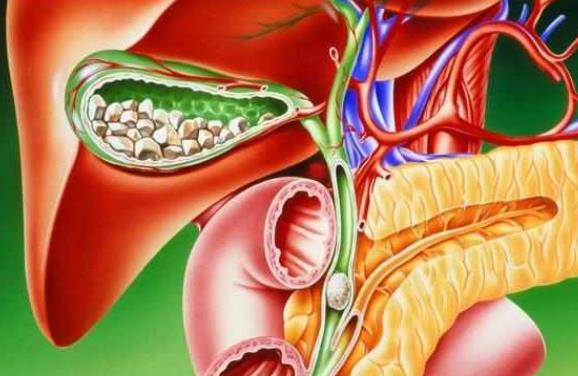 膽結(jié)石不能吃什么 膽結(jié)石多大必須做手術