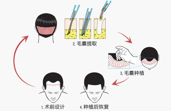 植發(fā)可以改善自然卷嗎 轉(zhuǎn)移毛囊不能改變基因